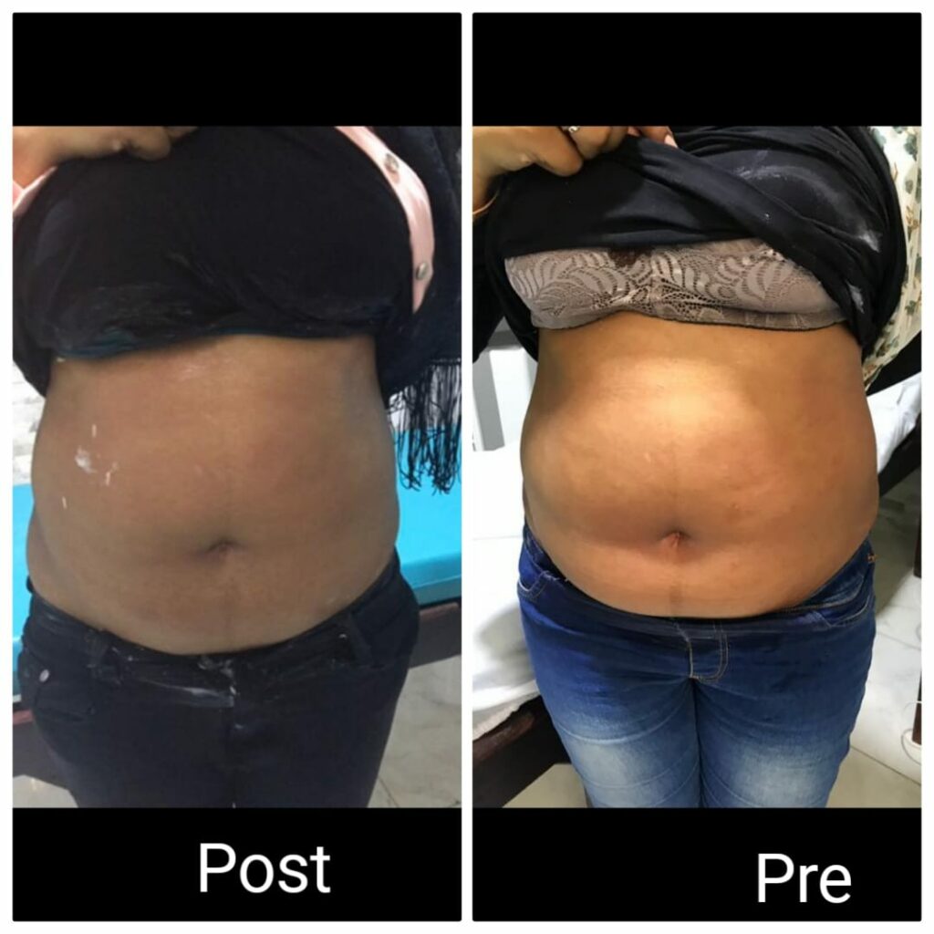 النتيجة بعد 3 جلسات في الغردقة